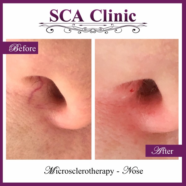 Microsclerotherapy - Nose